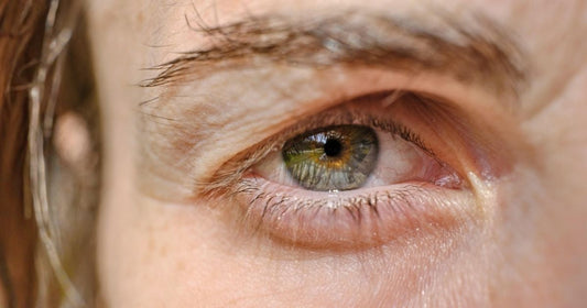 Dark under eye circles